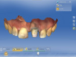 The preparation and adjacent teeth were scanned.