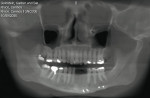 Figure 18  A Panorex of the patient following a traumatic accident to the lower jaw. Teeth Nos. 22 through 25 were lost.