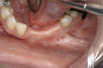 Figure 19  Clinical views of the edentulous span after extraction and ridge augmentation.