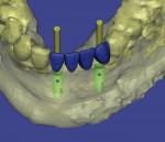 Figure 20  The 3D treatment plan shows the precise selection of 3.3-mm implants, the placement in the areas of teeth Nos. 22 through 25.
