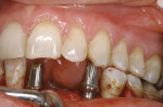 Figure 24  Permanent titanium Hex-Lock Contour Abutments that correspond to the plastic try-ins were permanently inserted to allow for immediate non-functional loading on the day of surgery.