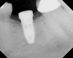 Figure 7  Wide-platform dental implant placed 3 months after extraction.