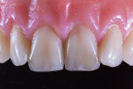 Fig 9. The esthetic vestibular flange on the completed denture.