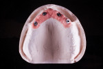 Fig 1. The master model with the artificial gingiva and analogs in position.