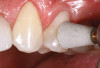Fig 6. Subtle differences can be seen in the positions of denture teeth on a trial base.