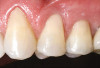 Fig 9. The selected denture teeth on the bite rim.