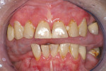 Figure 3  Xerostomia resulting from Sjögren’s syndrome with rampant dental caries.