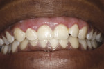 Case 1: 10-day postoperative photograph. Note poor hygiene, which may compromise results
if not improved.