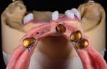 Fig 8 through Fig 10. The tooth positioning is transferred to the corrected master cast using a silicone putty matrix, and a complete wax try-in with hardware is performed.