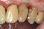 Figure 3  A large composite resin restoration was present on the mesial aspect of the tooth. A large carious lesion was present on the distal portion.