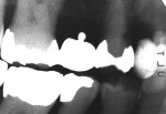 Figure 4  Preoperative radiograph shows the extent of the previous restorative treatment.