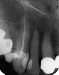 Figure 5  Radiograph taken after endodontic therapy was completed.