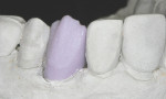Figure 14  The pre-crystallized milled crown in place on the reflective stone with the incisal cutback for layering.
