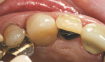 Figure 18  Incisal view of the completed restoration cemented in place.