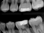 16-year-old patient referred for evaluation of painful tooth No. 19. Treatment options included saving the tooth with root canal therapy, crown lengthening surgery, and restoring the crown. Extraction and implant replacement could not be considered an option until skeletal growth is complete