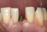 Figure 5B  Fixture seated with Manual Snap-In Key Driver. Note initial insertion was done with the Handpiece Driver. The gingival sleeve was now subgingival (this will prevent resin from locking under the fixture). A radiograph was taken to verify th