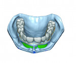 Fig 2. Marking the location of the gingiva and creating proper hygienic minimal ridge
overlap.