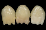 Figure 10  Mamelon was applied with GC Flo dentin 93, 92, and 91 (left to right) to the sample crowns.
