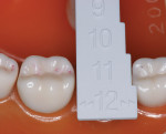 Figure 2  Use of a sizing gage for posterior teeth (Image courtesy 3M ESPE.)