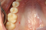 Figure 1  Pretreatment view of tooth No. 13.