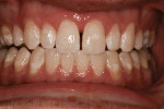 Fig 6. Final whitening results were a pleasing, bright dentition.