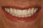 Fig 9. Close-up view of patient’s smile after final adjustments.