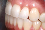 Figure 2  Preoperative left lateral retracted view of the patient’s teeth, revealing discoloration and deeper hue.