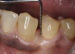 Fig 12. Follow-up at 15 months after surgical removal of cyst and bone graft placement. Note the gingival health of the treated area along with shallow probing depths.
