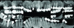 Fig 2. Pretreatment radiographs. Note the
advanced caries, periodontal involvement, and
periapical radiolucencies.
