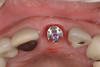 Darkened teeth after silver diamine fluoride treatment. Photos courtesy of Dr. Travis Nelson.