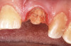 Fig 5. Virtual design of maxillary (Fig 4) and mandibular (Fig 5) provisional restorations, transparent view.