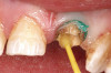 Fig 11. Intraoral frontal view of the maxillary zirconia restoration and adjusted mandibular PMMA prototype.