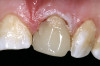 Fig 15. Intraoral frontal view of completed maxillary and mandibular zirconia restorations.