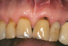 Fig 18. Intraoral occlusal views of maxillary (Fig 18) and mandibular (Fig 19) zirconia restorations at 1.5 years.