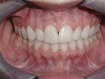 Fig 4. Six-month post-treatment with immediate placement and temporization of implant.