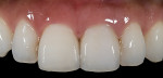 Figure 16  Postoperative view of a Lava and VM9 crown on tooth No. 9 and a mini-veneer made of VM9 on tooth No. 8.