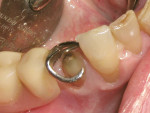 Figure 2  The RPD was placed in the mouth to ensure adequate reduction after tooth preparation.
