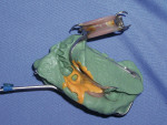 Figure 6  The impression and the RPD were removed in one piece.