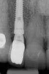Fig 18. Three-year postoperative periapical view showing maintenance of the crestal bone level from the time of implant placement throughout follow-up, Case 2. Note complete bone fill on distal aspect of implant in comparison with Figure 14.