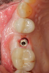 Fig 32. Occlusal view, 4.5-mm x 10-mm tapered implant just after flapless placement, position No. 4, Visit 2, Case 4.