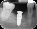 Fig 44. Periapical view, implant and healing abutment, Visit 3, Case 5.