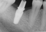 Fig 47. Periapical view, stock abutment and implant prior to extraoral cementation to PFM crown, Visit 4, Case 5.