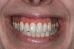 Fig. 1 Preoperative smile showing excessive gingival display.