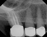Fig. 7 Periapical radiograph of tooth No. 2 shows extensive caries on the distal aspect under the crown margin.