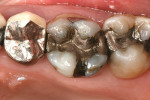 Figure 1  Preoperative view of tooth No. 14.