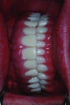 Fig. 25 The successful restorations are shown in the patient’s mouth on recall visits.