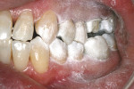 Figure 6  Dentition powdered in maximum intercuspation.