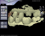 Figure 7  Digital scan of the occlusal relationship.