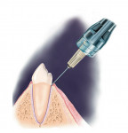Figure 3  Approach the tooth at about a 45° angle to the vertical, and place the needle in the gingival sulcus, with the bevel toward the tooth.