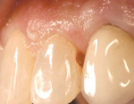 Figure 1  At the hygiene visit, a proximal gingival carious lesion was detected on a maxillary lateral incisor.